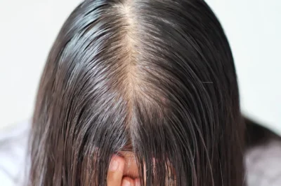 5 Simple Home Remedies to Tackle Oily Scalp Woes