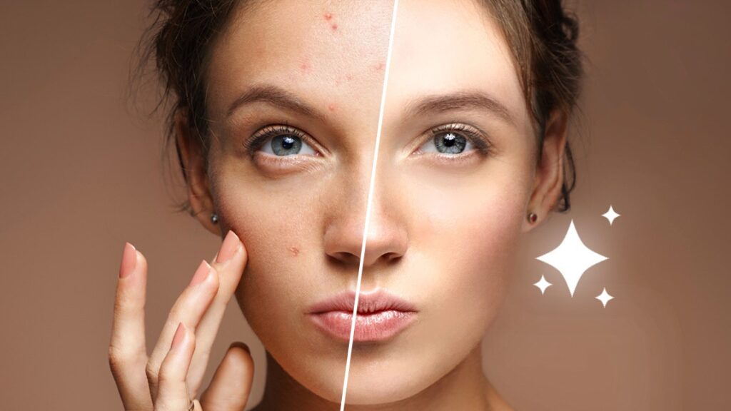 Home Remedies for Acne Removal