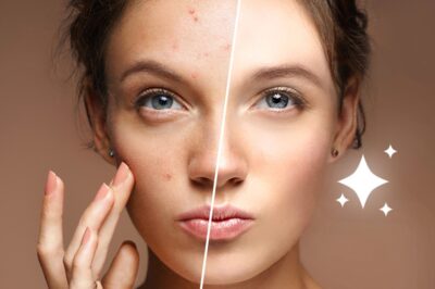 The Best Home Remedies for Acne Removal